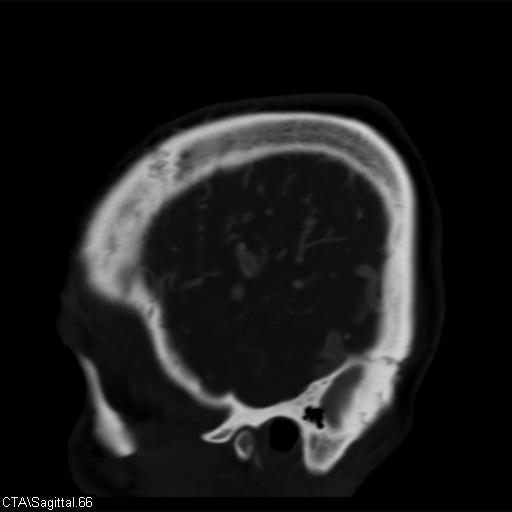Cerebral arteriovenous malformation (Radiopaedia 28518-28759 D 63).jpg