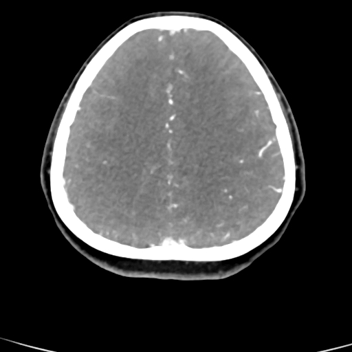 File:Cerebral arteriovenous malformation (Radiopaedia 73830-84645 B 28).jpg