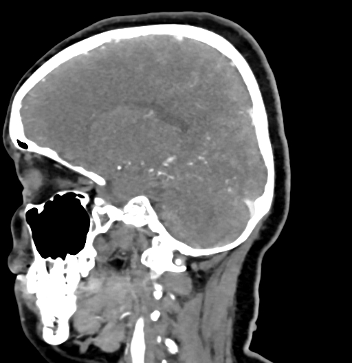 Cerebral arteriovenous malformation (Radiopaedia 73830-84645 D 36).jpg