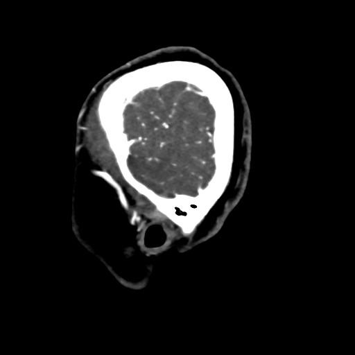 Cerebral arteriovenous malformation (Radiopaedia 73830-84645 Sagittal C+ delayed 7).jpg