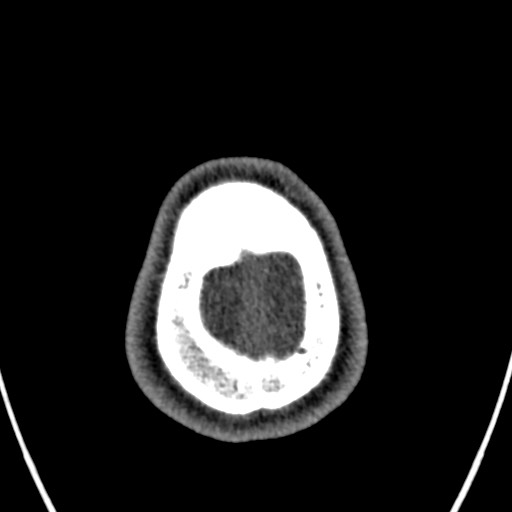 Cerebral arteriovenous malformation (Radiopaedia 78188-90746 Axial non-contrast 172).jpg