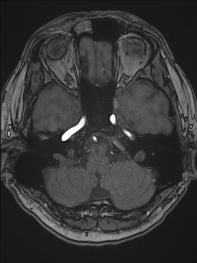 Cerebral arteriovenous malformation (Radiopaedia 84015-99245 Axial TOF 72).jpg