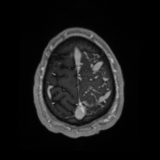 Cerebral arteriovenous malformation - huge (Radiopaedia 35734-37272 Axial T1 C+ 67).png