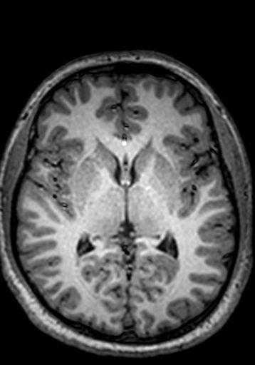 Cerebral arteriovenous malformation at posterior body of corpus callosum (Radiopaedia 74111-84925 Axial T1 143).jpg