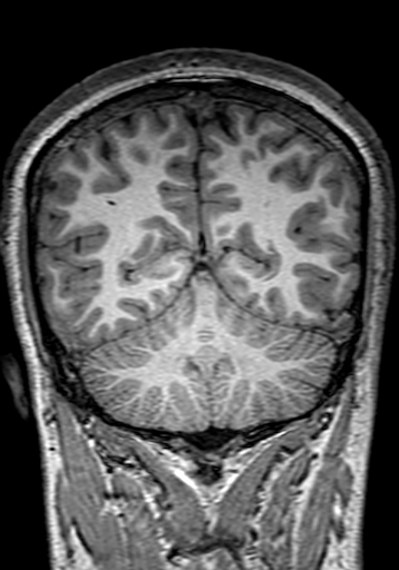 Cerebral arteriovenous malformation at posterior body of corpus callosum (Radiopaedia 74111-84925 Coronal T1 257).jpg