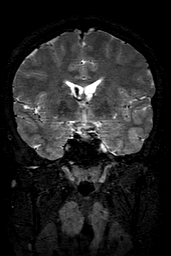Cerebral arteriovenous malformation at posterior body of corpus callosum (Radiopaedia 74111-84925 Coronal T2 76).jpg