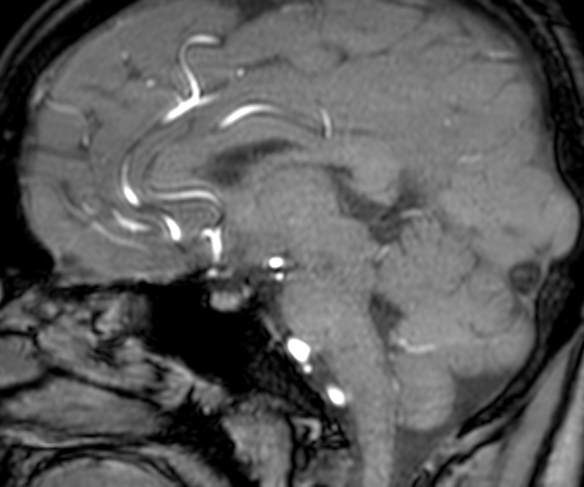 File:Cerebral arteriovenous malformation at posterior body of corpus callosum (Radiopaedia 74111-84925 J 204).jpg