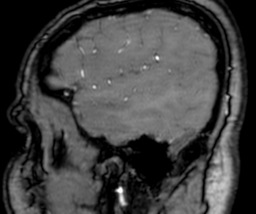 Cerebral arteriovenous malformation at posterior body of corpus callosum (Radiopaedia 74111-84925 J 36).jpg