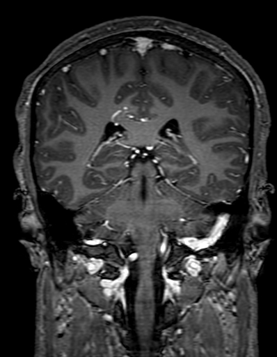 Cerebral arteriovenous malformation at posterior body of corpus callosum (Radiopaedia 74111-84925 K 234).jpg
