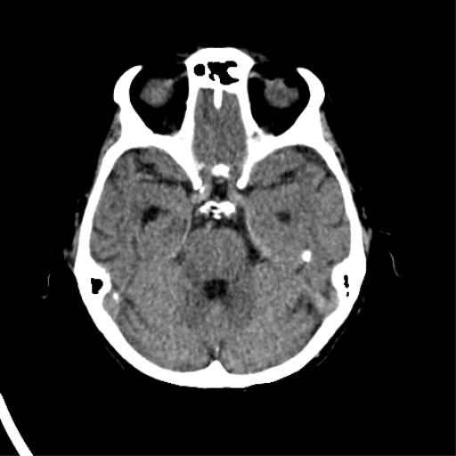 File:Cerebral arteriovenous malformation with lobar hemorrhage (Radiopaedia 44725-48510 Axial non-contrast 16).png