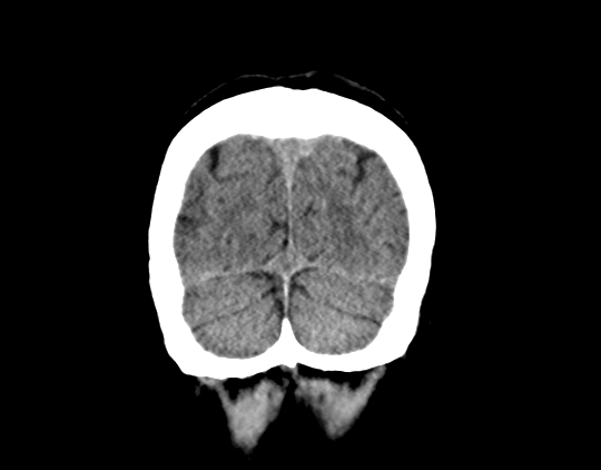 File:Cerebral arteriovenous malformation with lobar hemorrhage (Radiopaedia 44725-48510 Coronal non-contrast 42).png