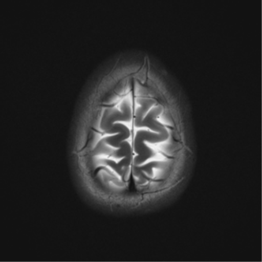 File:Cerebral cavernoma and development venous anomaly (Radiopaedia 37603-39482 Axial T2 21).png