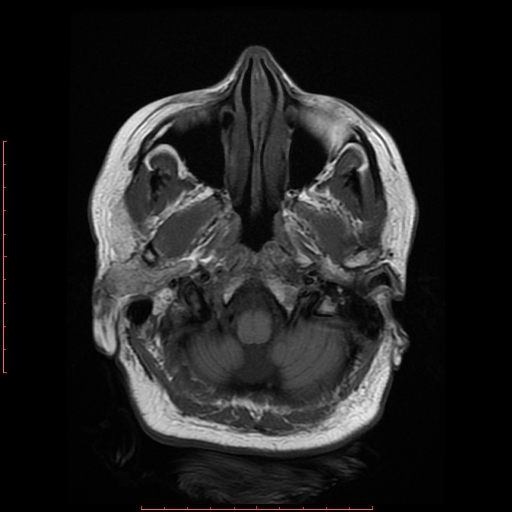 File:Cerebral cavernous malformation (Radiopaedia 26177-26306 Axial T1 4).jpg