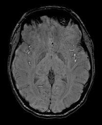 File:Cerebral cavernous venous malformation (Radiopaedia 70008-80021 I 36).jpg
