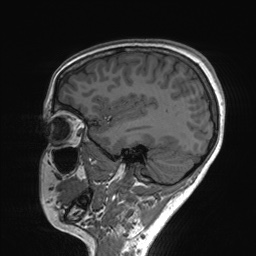 File:Cerebral cavernous venous malformation (Radiopaedia 70008-80021 Sagittal T1 55).jpg