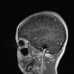 Cerebral cavernous venous malformation (Radiopaedia 70008-80021 Sagittal T1 C+ 19).jpg