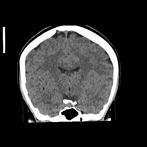 File:Cerebral cavernous venous malformation (Radiopaedia 70008-80022 non-contrast 34).jpg