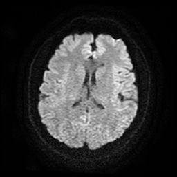 Cerebral cavernous venous malformation (Zabramski type II) (Radiopaedia 85511-101198 Axial DWI 52).jpg