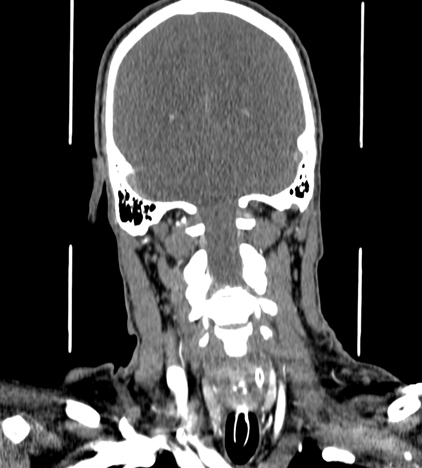 Cerebral edema in an overdose patient (Radiopaedia 72005-82539 B 112).jpg