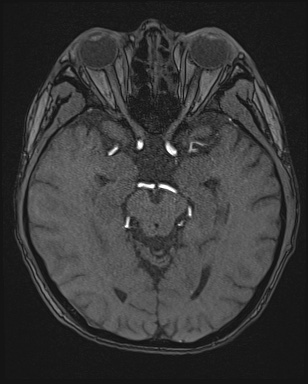 Cerebral embolic infarcts (embolic shower) (Radiopaedia 72391-82921 Axial MRA 63).jpg