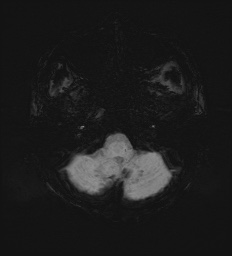 Cerebral embolic infarcts (embolic shower) (Radiopaedia 72391-82921 Axial SWI 9).jpg