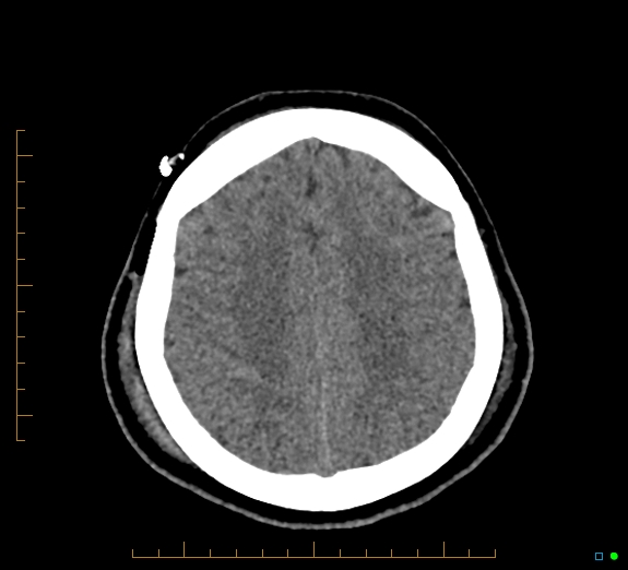 Cerebral fat embolism (Radiopaedia 85521-101224 Axial non-contrast 39).jpg