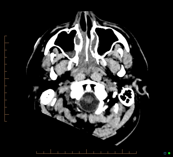 Cerebral fat embolism (Radiopaedia 85521-101224 Axial non-contrast 4).jpg