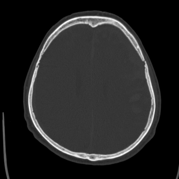 Cerebral hemorrhagic contusions (Radiopaedia 23145-23188 Axial bone window 38).jpg