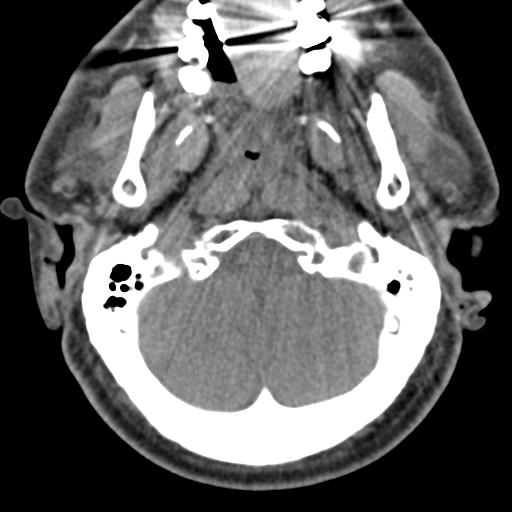 Cerebral hemorrhagic contusions and cervical spine fractures (Radiopaedia 32865-33841 F 6).jpg
