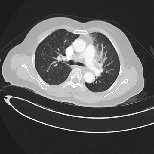 Cerebral metastases (Radiopaedia 33041-34055 Axial lung window 22).png