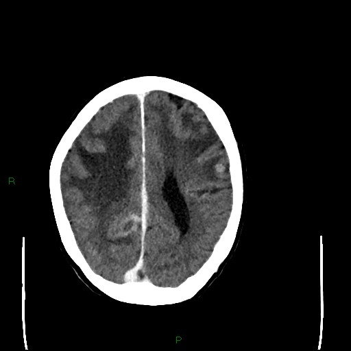 File:Cerebral metastases - breast primary (Radiopaedia 77653-89857 Axial C+ delayed 78).jpg