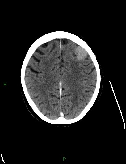 Cerebral metastases - ependymal and parenchymal (Radiopaedia 79877-93131 Axial C+ delayed 60).jpg