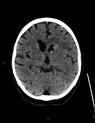 Cerebral metastases - ependymal and parenchymal (Radiopaedia 79877-93131 Axial non-contrast 35).jpg