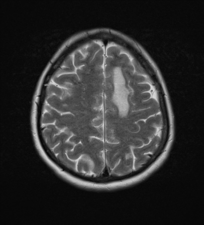 File:Cerebral metastases mimicking abscesses (Radiopaedia 45841-50131 Axial T2 22).png