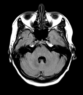 File:Cerebral metastasis (Radiopaedia 46744-51248 Axial FLAIR 7).png
