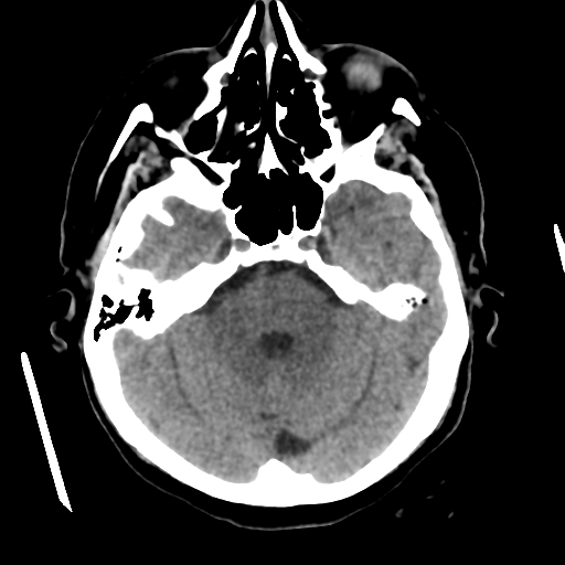 File:Cerebral metastasis to basal ganglia (Radiopaedia 81568-95412 Axial non-contrast 21).png