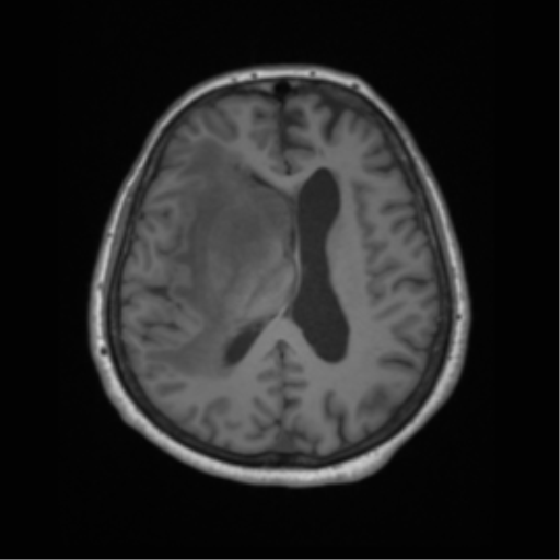 File:Cerebral metastasis to basal ganglia (Radiopaedia 81568-95413 Axial T1 44).png