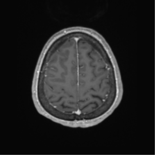 Cerebral metastasis to basal ganglia (Radiopaedia 81568-95413 Axial T1 C+ 62).png