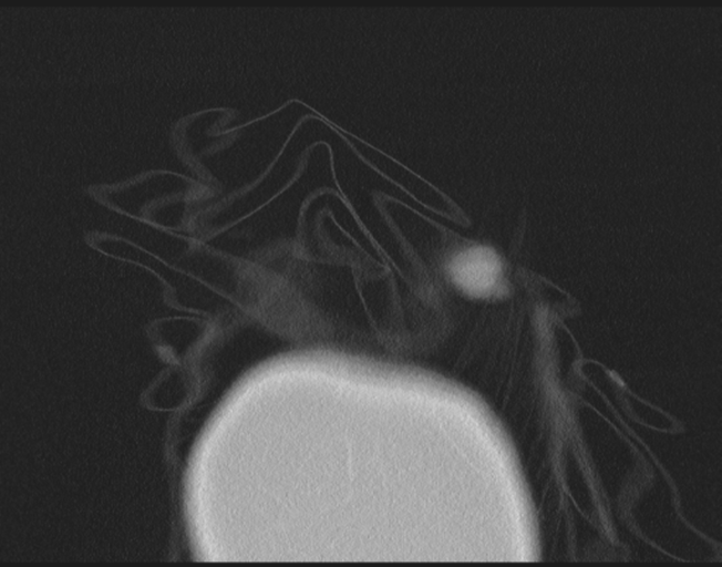Cerebral metastasis to basal ganglia (Radiopaedia 81568-95414 Coronal lung window 2).png