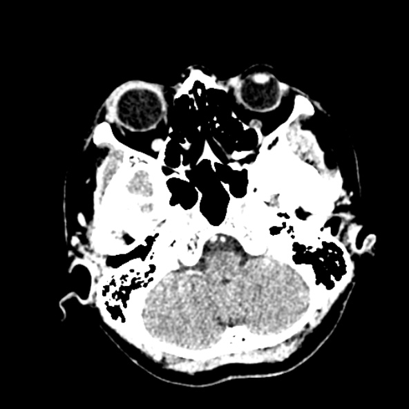 File:Cerebral ring enhancing lesions - cerebral metastases (Radiopaedia 44922-48818 B 55).jpg