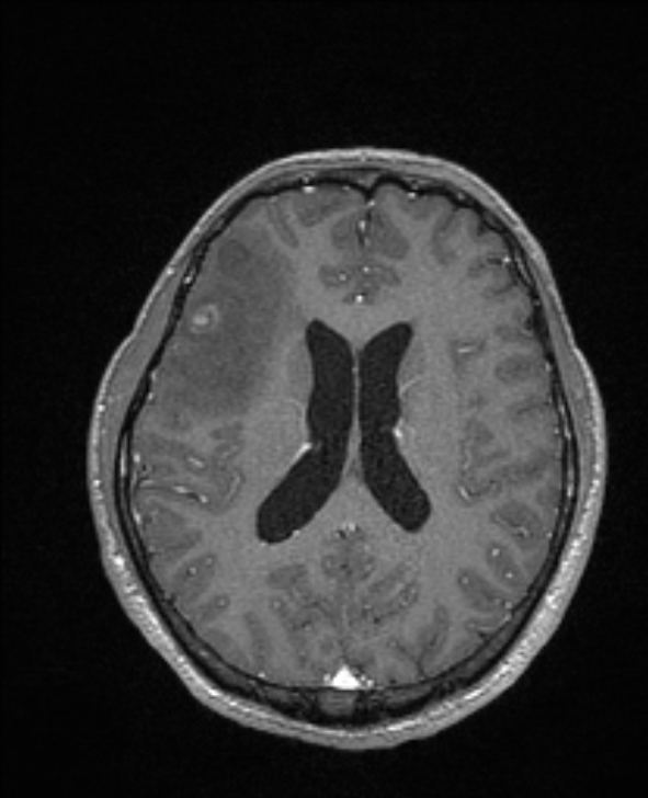 Cerebral toxoplasmosis (Radiopaedia 85779-101597 Axial T1 C+ 99).jpg