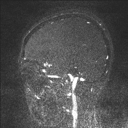 Cerebral tuberculosis with dural sinus invasion (Radiopaedia 60353-68090 Sagittal MRV 39).jpg