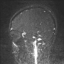 Cerebral tuberculosis with dural sinus invasion (Radiopaedia 60353-68090 Sagittal MRV 45).jpg