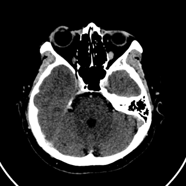 File:Cerebral venous hemorrhagic infarct from venous sinus thrombosis (Radiopaedia 55433-61883 Axial C+ delayed 107).jpg