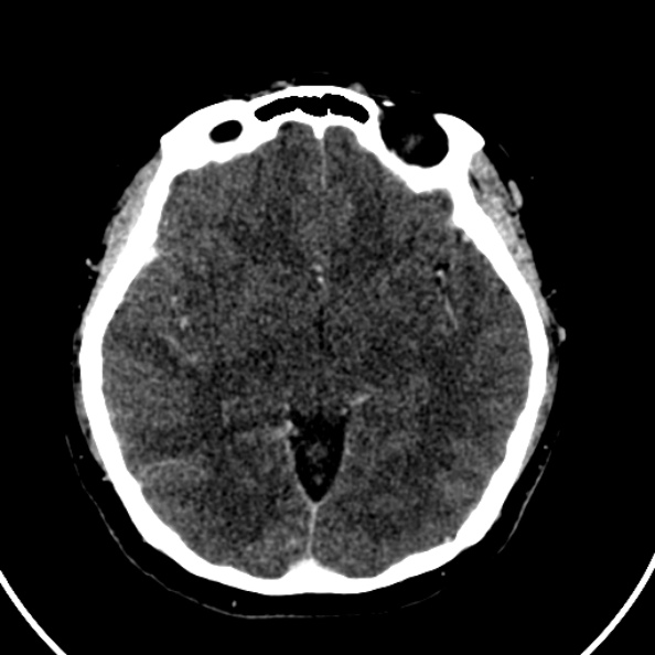 File:Cerebral venous hemorrhagic infarct from venous sinus thrombosis (Radiopaedia 55433-61883 Axial C+ delayed 84).jpg