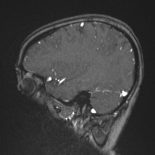 Cerebral venous infarction - hemorrhagic (Radiopaedia 81625-95505 Sagittal MRV 57).jpg