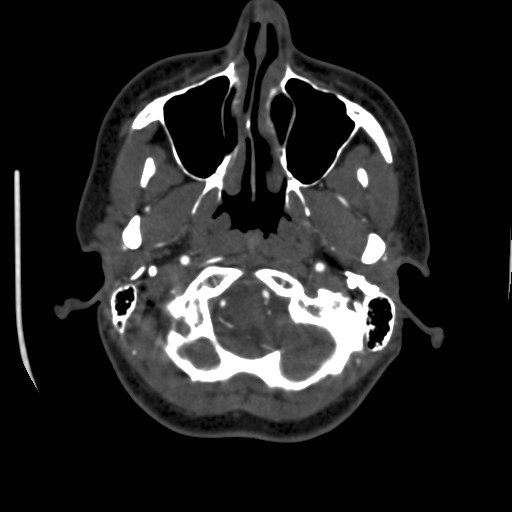 Cerebral venous sinus thrombosis (Radiopaedia 40619-43227 A 24).jpg