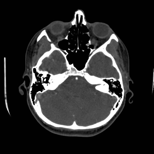 Cerebral venous sinus thrombosis (Radiopaedia 40619-43227 A 56).jpg