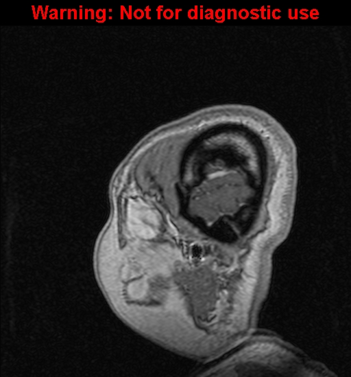Cerebral venous thrombosis (Radiopaedia 37224-39208 Sagittal T1 C+ 12).jpg