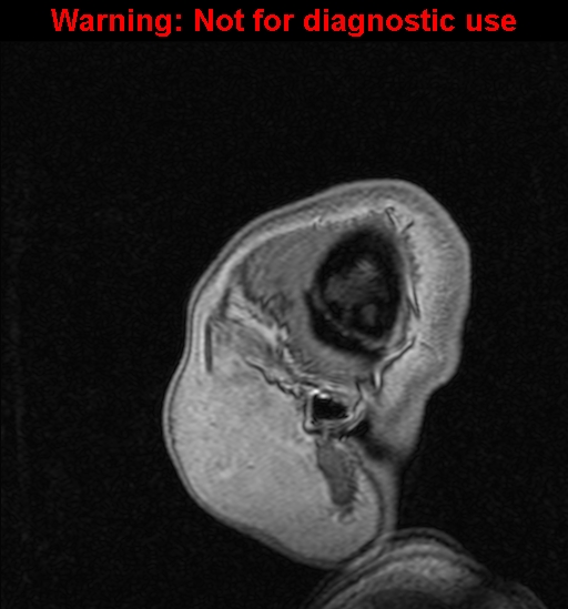 Cerebral venous thrombosis (Radiopaedia 37224-39208 Sagittal T1 C+ 8).jpg
